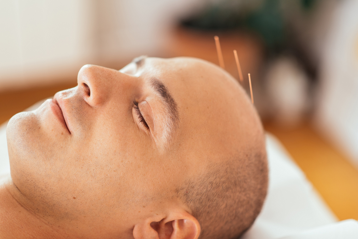 Acupuncture treatment on head