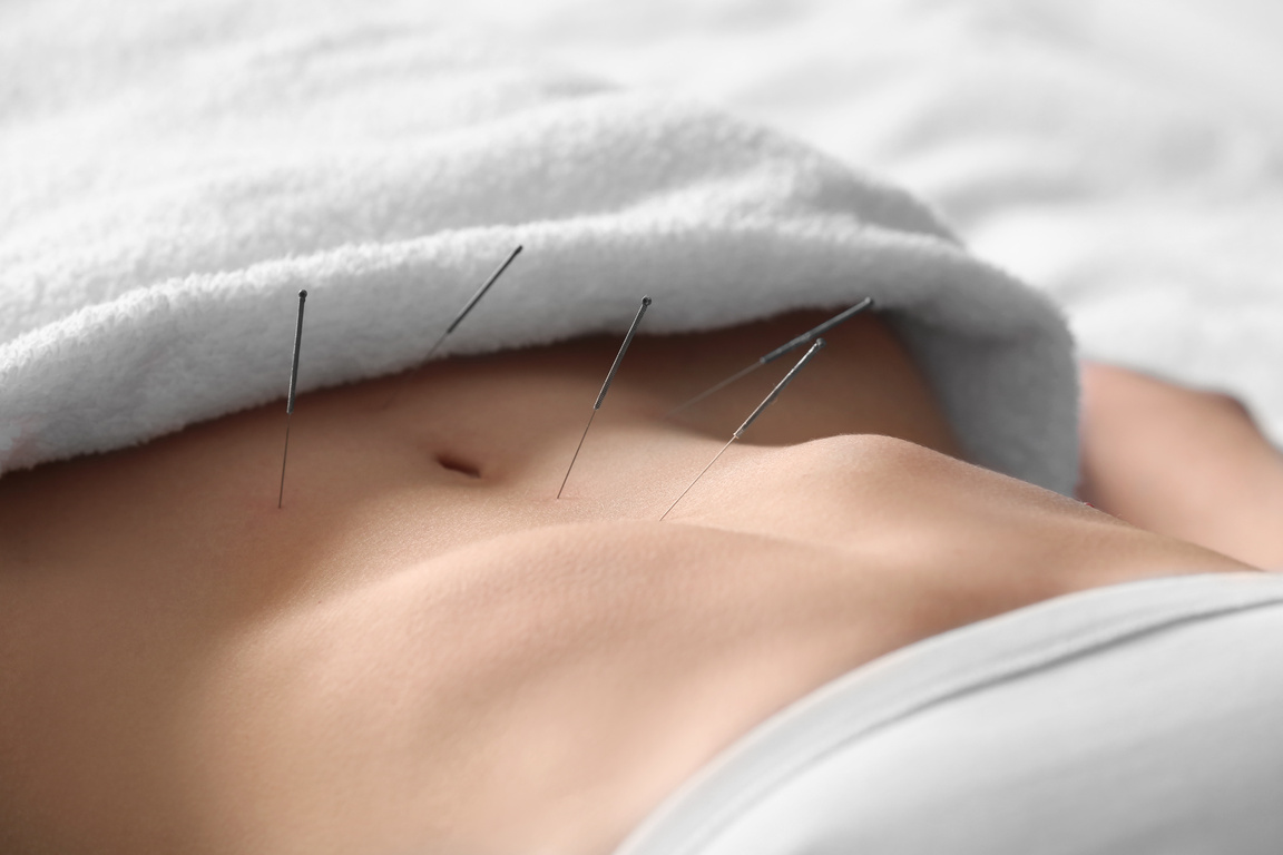 Young Woman Undergoing Acupuncture Treatment