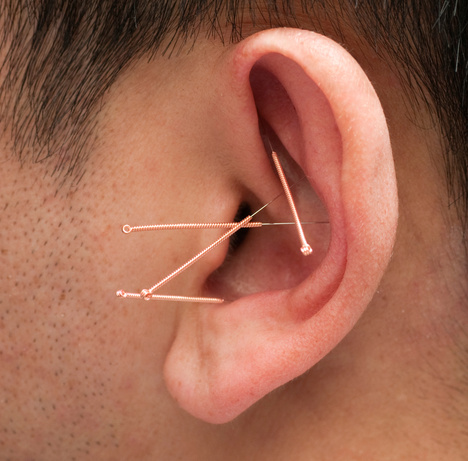 Close-up of male ear with 4 copper acupuncture needles in